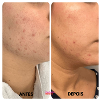 Lumi Skin - Ondas de luz para uma pele radiante