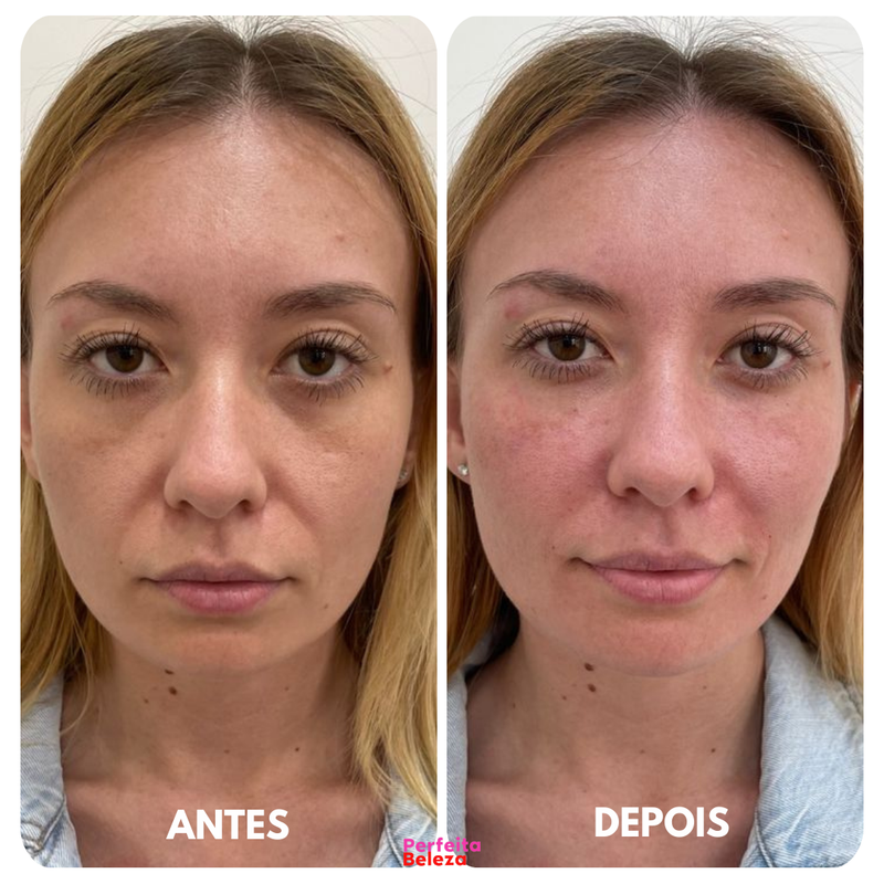 SkinLift - Definição imediata e efeito lifting SEM BOTOX